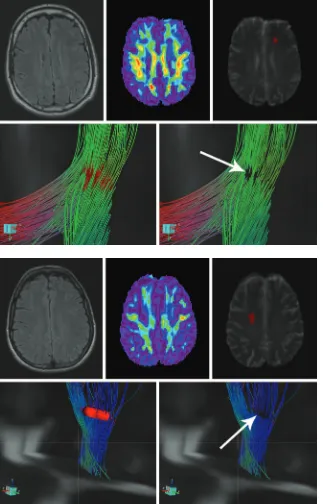 Fig 2. FLAIR scan, FA map, and fiber tracking in a 49-year-oldpatient with TBI who was imaged 16 months after the initialtrauma