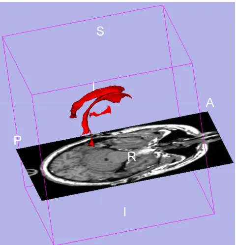Figure 13D ventricle model from 3D slicer sample visualization3D ventricle model from 3D slicer sample visualiza-tion