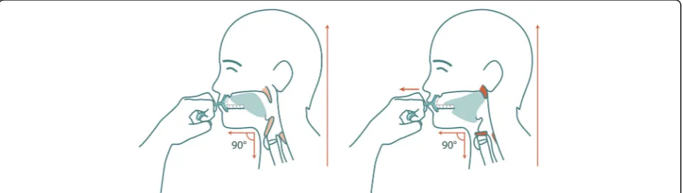 Fig. 1 Oral screen training. (Left) The oral screen is inserted predentally, behind closed lips