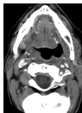 Fig 2. Patient 5, a 59-year-old woman status post 3.5 monthsB,posterior border (of radiation therapy (60 Gy) for treatment of squamous cellcarcinoma of the oral tongue, with a nonenhancing ulcerationwith negative biopsy results (category 1)