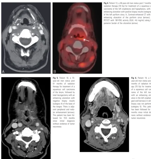 Fig 4. Patient 13, a 46-year-old man status post 7 months ofPET/CT with 18F-FDG activity (SUV, 4.6 mg/mL) along theposterior border of the ulceration (radiation therapy (70 Gy) for treatment of a squamous cellcarcinoma of the left oropharynx and hypopharyn