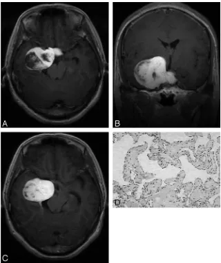 Fig 2. A 48-year-old man was admitted with an 8-year history of intermittent headache.A and B composition (type C pathologic features; H&E, original magnification,parasellar region