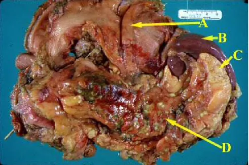 FIG 4 ACUTE PANCREATITIS SPECIMEN