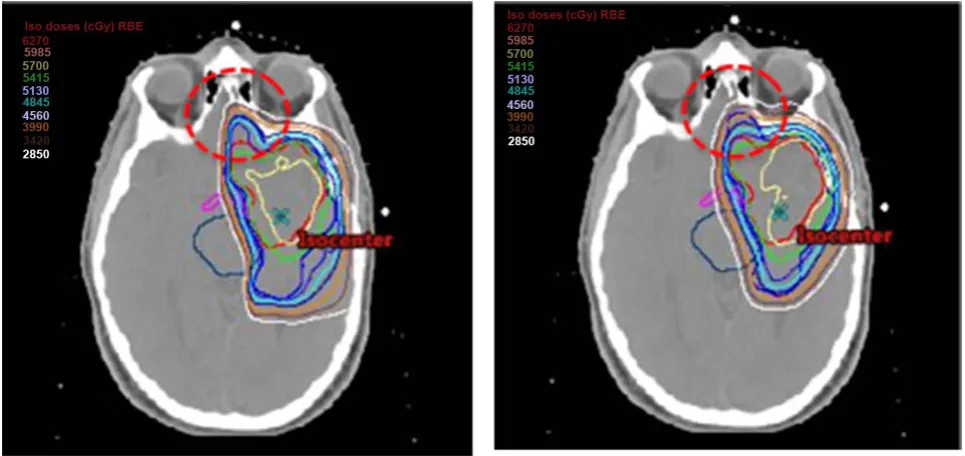 Figure 6. Comparison of isodose distributions obtained by the TPS (left) and the FDC (right) for plan L