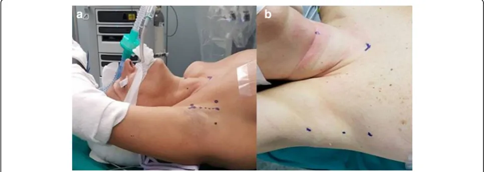 Fig. 3 a Patient positioning: the ipsilateral arm, padded, extended cephalad and flexed over the head is placed on a dedicated arm rest; bPatient positioning: extended ipsilateral arm secured in position