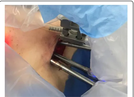 Fig. 7 Detail of dissection using three robotic arms through theaxillary incision (camera and instruments are ideally located at thethree sides of an equilateral pyramid)
