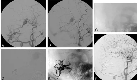 Fig 1. A 67-year-old man with a left temporal hematoma.compared with the occipital artery