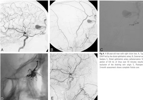 Fig 4. A 68-year-old man with right vision loss. A, Type IV