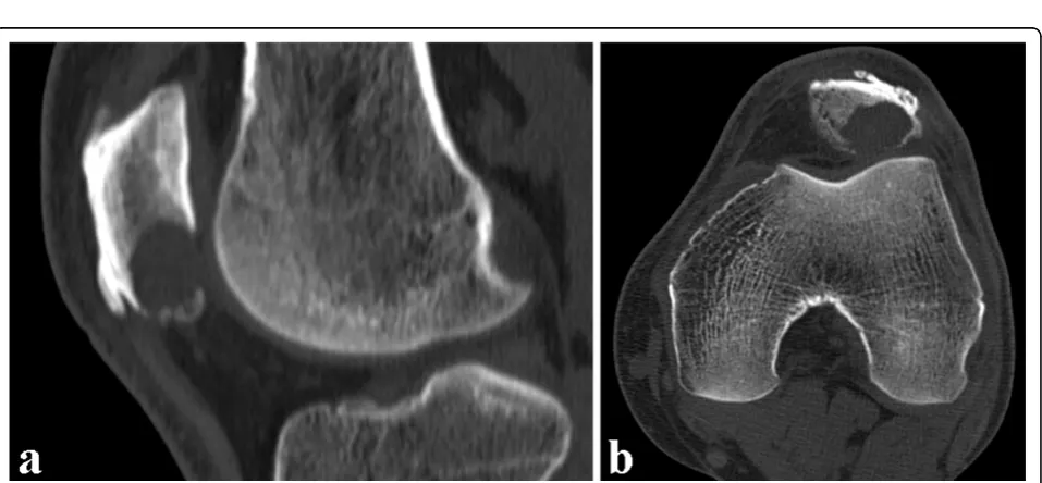 Figure 1 Magnetic resonance imaging of the left knee. MRI of the left knee showing a hyperintense lesion within the inferior pole of thepatella