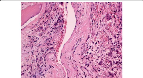 Figure 3 Histology sample. Histology sample showing a typical picture of aneurysmal bone cyst