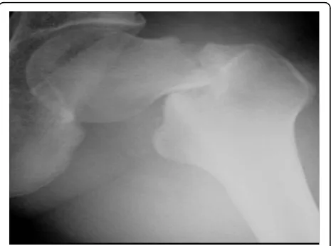 Figure 1 An anteroposterior X-ray of the left hip showing thefemoral neck fracture. The Devas classification showed that thefracture was a displaced type fracture.