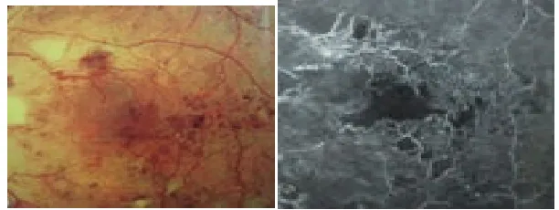 Fig 4  FOCAL MACULOPATHY WITH FOCAL LEAK PATTERN 