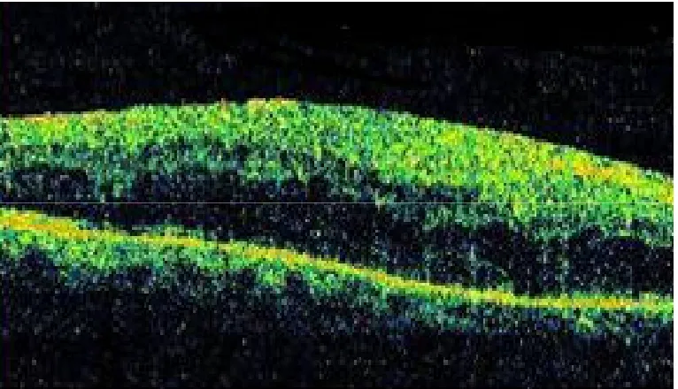 Fig 11  CYSTOID MACULAR EDEMA 