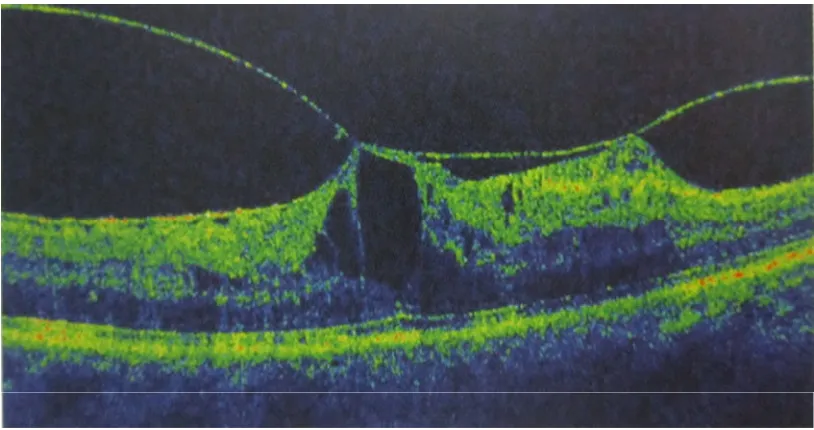 Fig 14 VITEROMACULAR TEACTION 