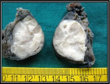 Fig-14: Follicular adenoma : Photomicrograph shows well  formed capsule encircling the tumor H&Ex100 (727/12) 