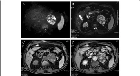 Fig. 1 CT scan showing a large homogeneous lesion with rareperipheral calcifications