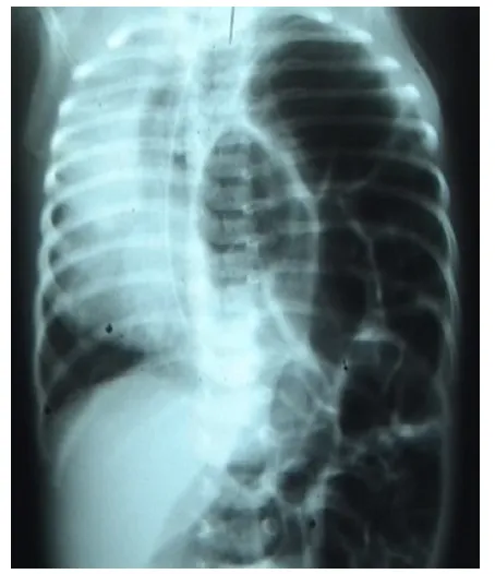 Fig -4. X –ray of Left Side CDH   