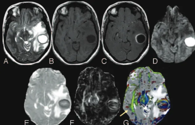 Fig 1. A 31-year-old female patient presenting with pyogenicFA (the MD map (similar to what is observed in the contralateral inferiorlongitudinal fasciculus and midbrain (brain abscess in the left temporal lobe