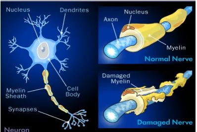 Figure 8. Demyelination of Myelin Sheath produces multiple sclerosis. 