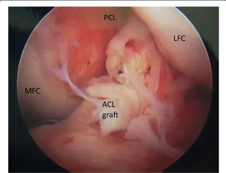 Figure 2 An arthroscopic view of the femoral notch in a leftknee demonstrating rupture of an anterior cruciate ligament(ACL) graft near its tibial attachment