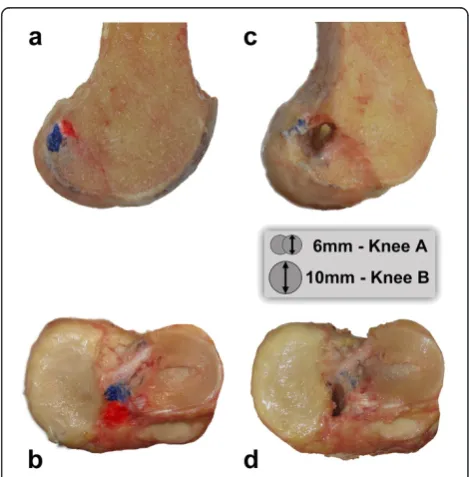 Figure 2 ACL footprint and tunnel position. atibia of knee A following resection of the native ACL
