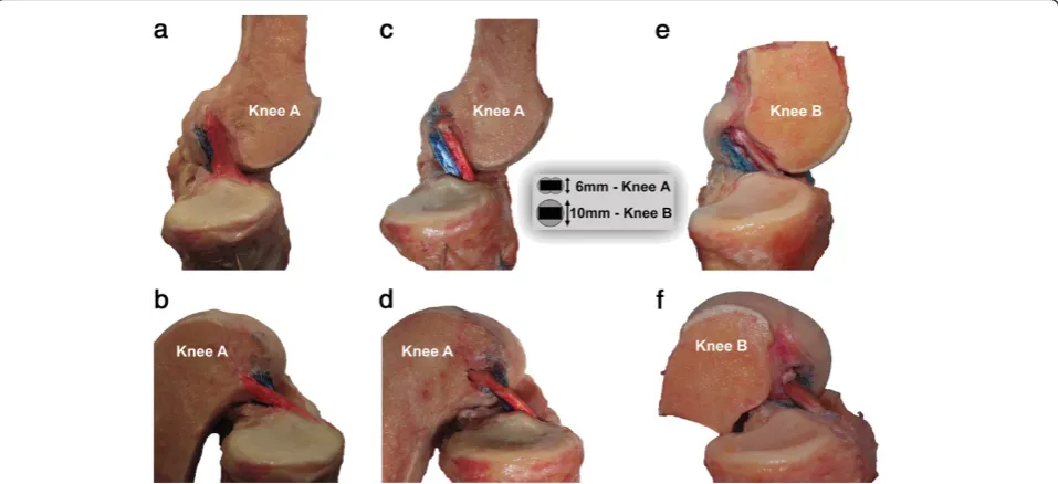 Figure 3 Physiologic and reconstructed ACL movement pattern. A medial view of the native ACL of knee A in full extension (a) and flexion(b)