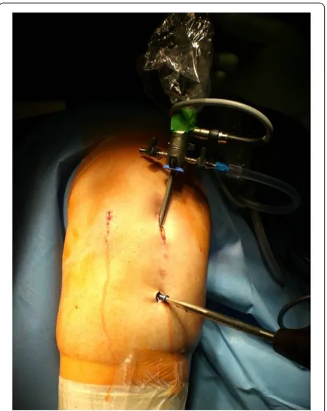 Figure 1 Right knee, dorsal view. Surgical access to remove alocking plate arthroscopic-assisted after HTO; the arthroscope is inthe standard medial portal.