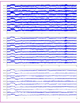 Figure 33 Example of MEG data at different stages of preprocessing. The same 20 seconds of data (from the experiment presented in Chap