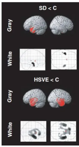 Figure 18 White and gray matter changes in SD and HSVE patients. Pathology is centered on the anterior temporal lobe in both cases, but the disease spreads in very different ways