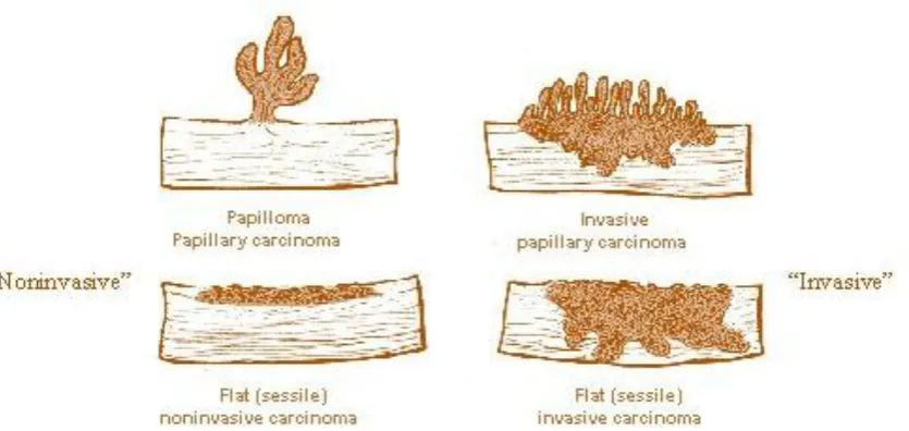 Figure 1: Gross types of bladder cancers 