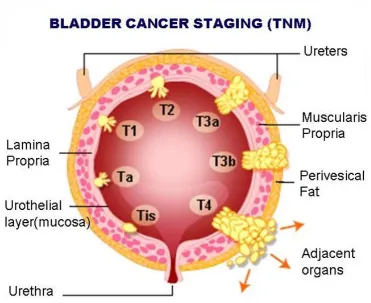 Figure 2: Staging of bladder cancers 