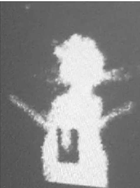 Figure 9Dynamic view of the flapEvaluation of the flap with Technetium-99m scintigraphy: Evaluation of the flap with Technetium-99m scintigraphy: Dynamic view of the flap