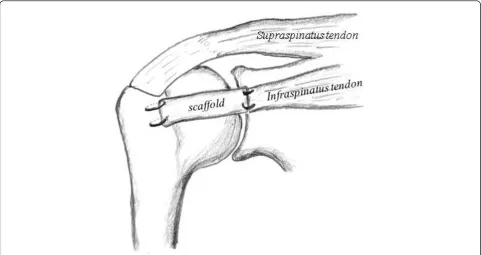Figure 2 A schematic drawing of the repair of the rotator cuff defect using PLLA scaffold in a rabbit model