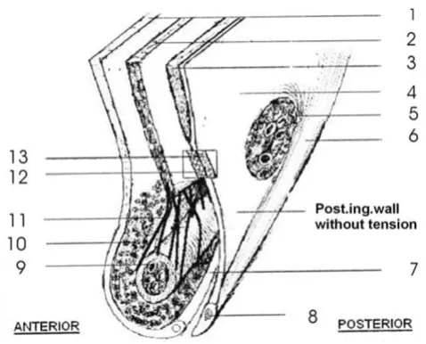 Figure 4Changes during raised intra abdominal pressure. A) Contraction of transversus abdominis muscle pulls the poste-rior inguinal wall above and laterally creating tension in it (Dynamic shielding action), B) External oblique aponeurosis and posterior inguinal wall come closer (anterior-posterior compression action), C) Squeezing action and pulling effect of cremasteric muscle, D) Dense and strong cremasteric fascia exerts binding effect on structures in the inguinal canal for their optimal dynamic movements.