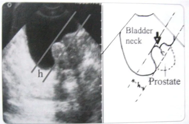 Figure 5  - Measurement of bladder wall thickness 