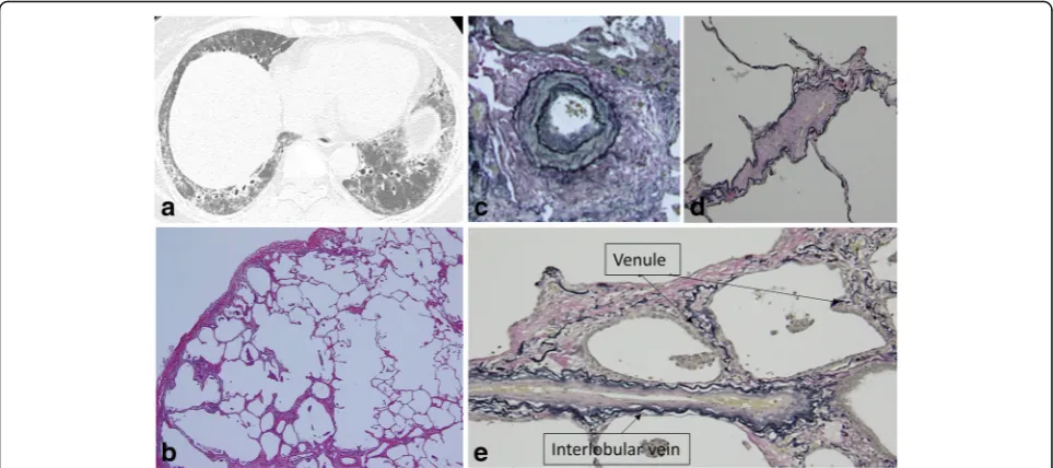 Fig. 4 HRCT and surgical lung biopsy of 58-year-old never-smoking woman.staining, × 200).(Elastica van Gieson staining, × 100)