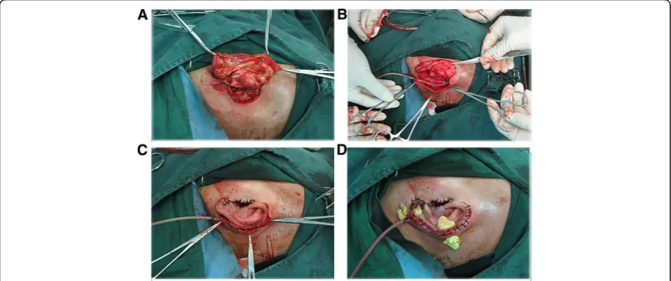 Fig. 1 The left auricle was amputated completely, the external acousticmeatus was exposed