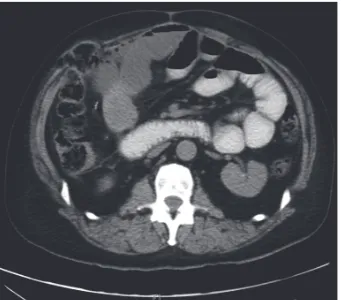 Figure 3: ST elevation in inferior and lateral leads (case 1).
