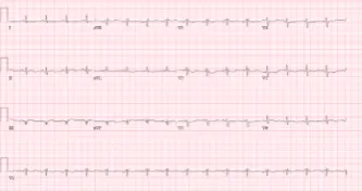 Figure 6: Coronary angiography showing no obstructive coronary artery lesions responsible for ST elevation (case 2).