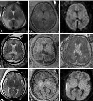 Fig 1. Correlation between WM MR signals and DWI abnor-malities is shown on T1 (A,D,G), T2 (B,E,H), ADC map (F), andDWI (C,I) axial sections of the brains of group A and group Bfetuses