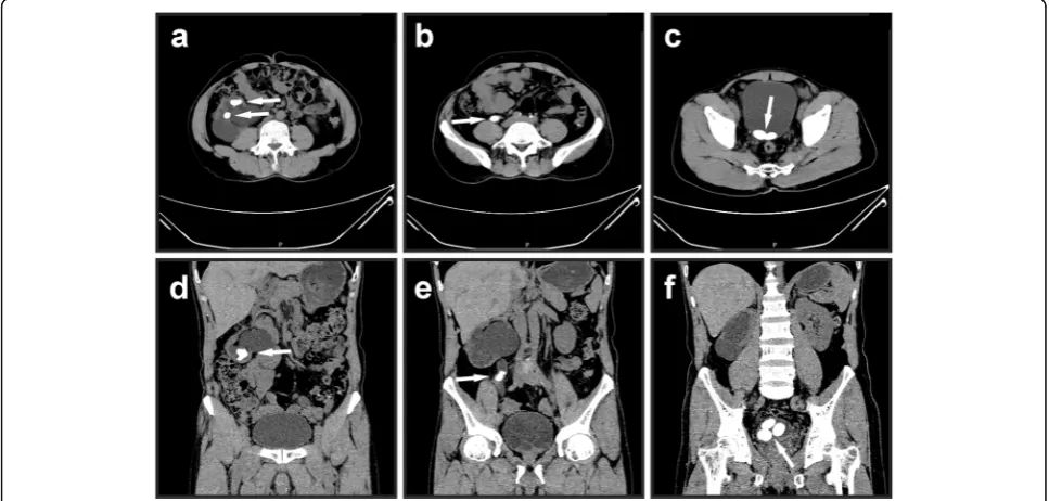 Fig. 1 Axial and coronal images of computed tomography showing multiple urinary tract calculi (white arrows)