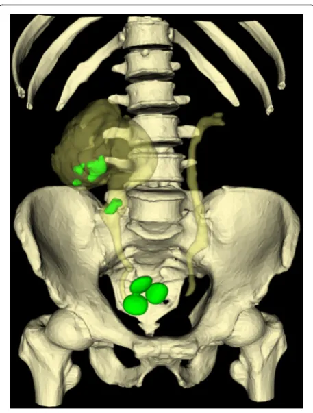 Fig. 3 The patient position and port placement for robot-assistedlaparoendoscopic single-site surgery