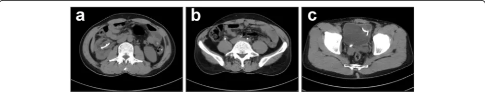 Fig. 4 Intraoperative images of the surgical procedure.removed by performing pyelolithotomy.with 4 a The ureter calculi is removed by performing ureterolithotomy