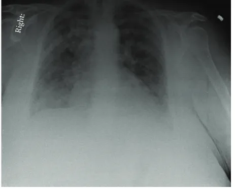 Figure 1: Chest radiograph showed acute bilateral pulmonaryinﬁltration, more conﬂuent in the areas of the right upper andbilateral lower lobes.