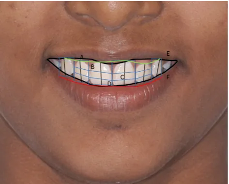 Figure 4 – DFAR with Cervical Line (A); Papillary Line (B); Contact Points 