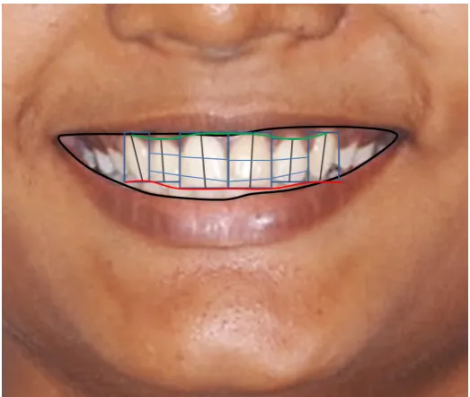Figure 5 – Case 1 Pre-treatment Smile Evaluation with DFAR 