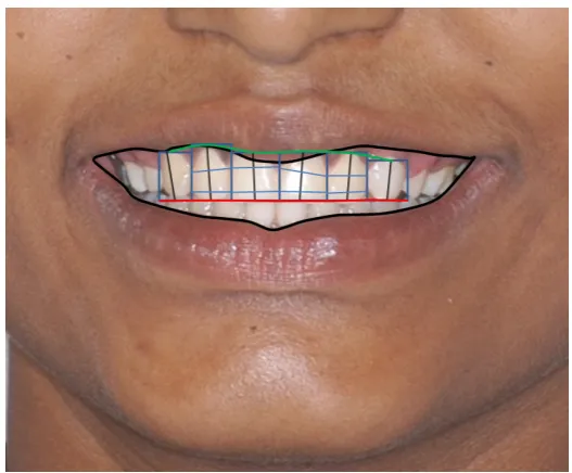 Figure 7 – Case 2 Pre-treatment Smile Evaluation with DFAR 