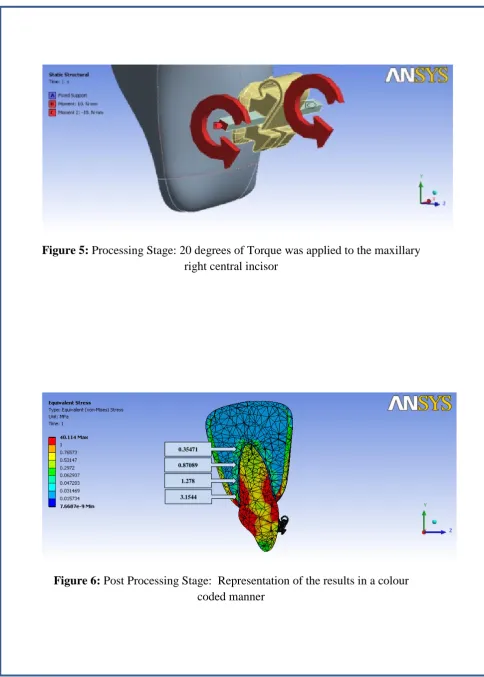 Figure 5: Processing Stage: 20 degrees of Torque was applied to the maxillary right central incisor 