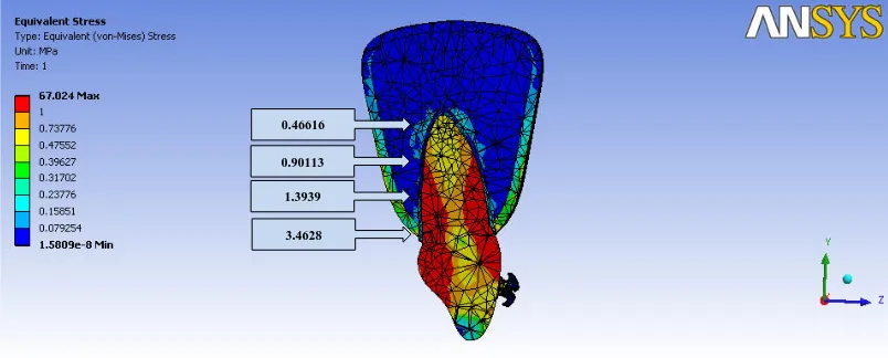 Figure 9: STRESS PATTERN ON THE TOOTH AND PERIODONTIUM BY “SMART CLIP-3” BRACKET 