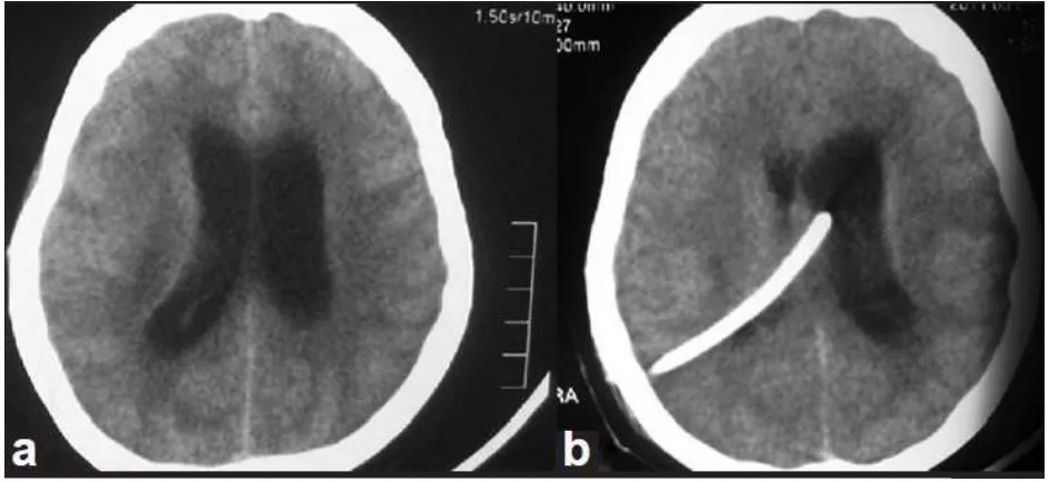 Figure 4: Neuro imaging in TBM. The image on the left shows the 